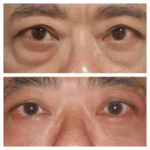Eye Bag Removal in Dubai