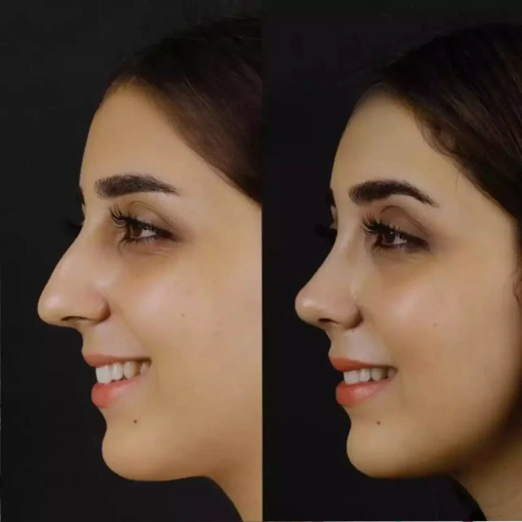 Rhinoplasty in Dubai