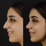 Rhinoplasty in Dubai