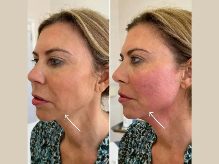 Endolift for Skin Tightening: Best Doctors in Dubai Explain Expected Results