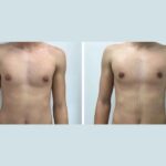 gynecomastia in dubai