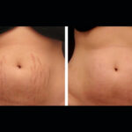 Experience Complete Rejuvenation with Radiofrequency (RF) Microneedling Treatments in Dubai