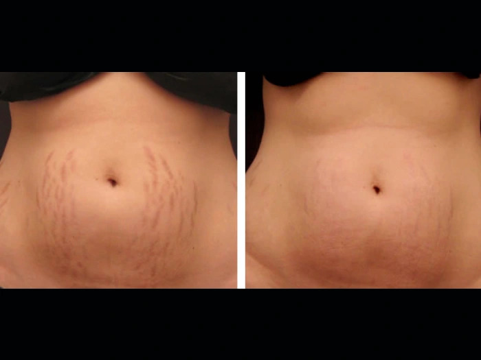 Experience Complete Rejuvenation with Radiofrequency (RF) Microneedling Treatments in Dubai