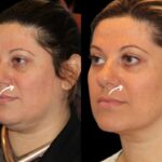 Sculptra Fillers Treatment in Dubai
