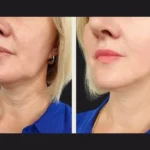 PRP Treatment in Dubai