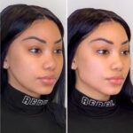 Benefits of Choosing Thread Lift Treatments in Dubai for Skin Tightening