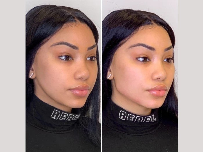 Benefits of Choosing Thread Lift Treatments in Dubai for Skin Tightening