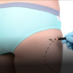 Why Choose Dubai for Buttocks Liposuction