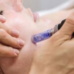 Why Choose Microneedling in Manchester for Skin Rejuvenation
