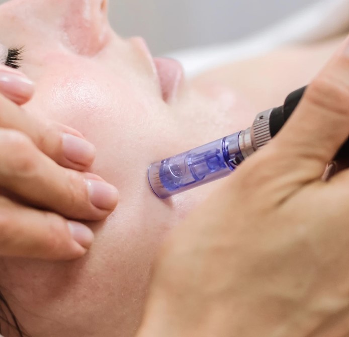 Why Choose Microneedling in Manchester for Skin Rejuvenation