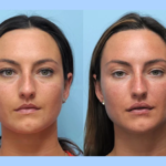 Lift and Tighten Your Skin with Thread Lift by the Best Plastic Surgeon in Dubai