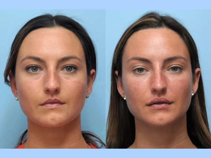Lift and Tighten Your Skin with Thread Lift by the Best Plastic Surgeon in Dubai